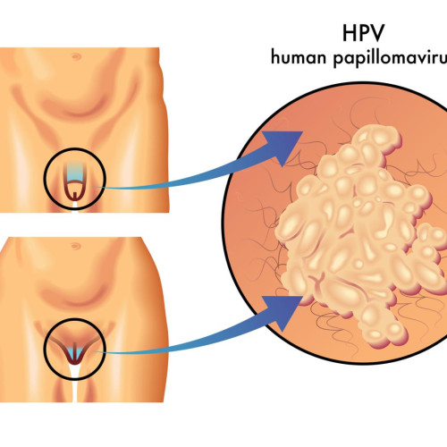 Човешки папиломен вирус и генитални брадавици
