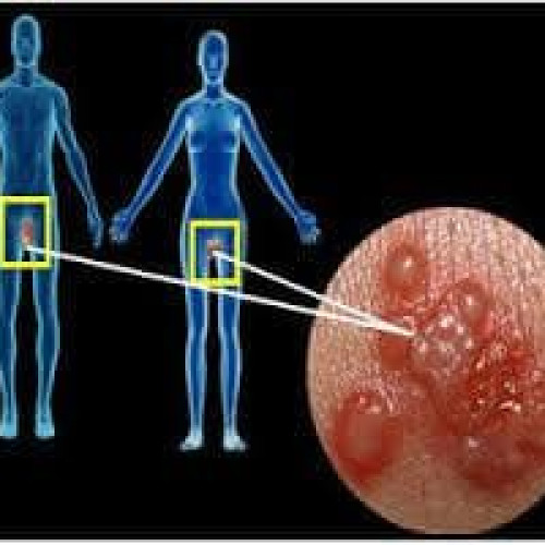 Гениталният херпес врата за ХИВ